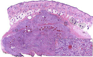 Moderately differentiated squamous cell carcinoma (hematoxylin eosin, original magnification ×10). The composition of the tumor, which consists of nests and strings of epithelial cells with extensive foci of keratotic differentiation, is shown in greater detail in the inset (hematoxylin eosin, original magnification ×400).