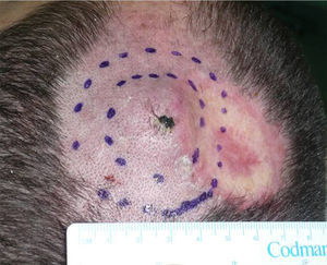 Recurrence of squamous cell carcinoma in the area close to the graft.