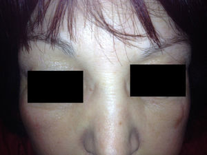 Bilateral palpebral swelling involving the nasal root 72hours after onset.