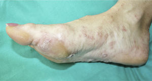 Palmoplantar vesicles of 24hours duration.