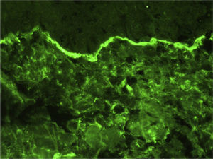 Direct immunofluorescence showing linear and homogeneous immunoglobulin A deposition.