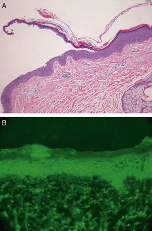 (a) Superficial acantholysis and hyperchromatic nuclei in the granular layer (hematoxylin–eosin, original magnification ×20) and (b) DIF at 40× magnification displaying segmental intercellular staining for IgG and C3.