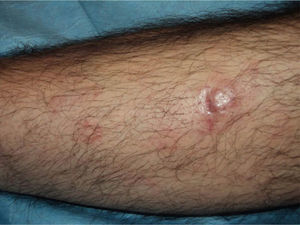 Image of a patient with marginal zone lymphoma in the leg.