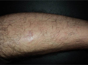 Resolution after 3 injections, each a week apart, of intralesional rituximab (10mg/mL).