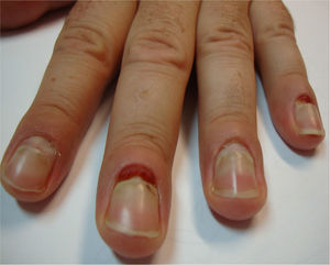 Pyogenic granulomas in the proximal nail fold of the second and fourth finger of the right hand and detachment of the nails of the second to fifth fingers.