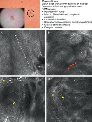 Clinical and dermoscopic images of pigmented basal cell carcinoma. A, RCM image (0.5×0.5mm) taken at a depth of approximately 30μm under the skin surface. Note the elongation (polarization) of the nuclei along the same axis (dashed line). B, RCM image (0.5×0.5mm) showing tumor islands with characteristic peripheral palisading (asterisks) and separation from stroma (e). C and D, Dilated vessels (arrows) nearby containing bright dendritic melanocytes. RCM images (0.5×0.5mm) showing the presence of a tumor (*) with intratumoral dendrites (yellow arrow). Note the clusters of melanophages (white arrows) in the stroma (e). RCM indicates reflectance confocal microscopy.