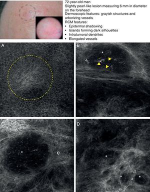 Clinical and dermoscopic images of basal cell carcinoma. A, RCM image (0.5×0.5mm) of lower part of the epidermis, showing epidermal shadowing (dashed circle). B, RCM image (0.5×0.5mm) of the dermis, showing nonrefractive tumor islands forming a dark silhouette pattern. Inside are dendritic cells (arrowheads) that appear to correspond to intratumoral melanocytes. C, RCM image (0.5×0.5mm) of the dermis, showing a nonrefractive tumor island (asterisk) forming a dark silhouette pattern surrounded by a reflective stroma (e). Note the presence of a refractive grainy material, possibly melanin, in the interior. D, RCM image (0.5×0.5mm) of the deep dermis, showing smaller nonrefractive tumor islands (asterisks). RCM indicates reflectance confocal microscopy.