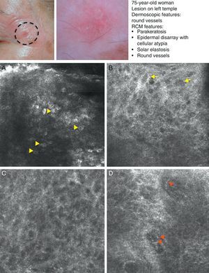 Clinical and dermoscopic images of squamous cell carcinoma in situ. A, RCM image (0.5×0.5mm) of the stratum corneum, showing numerous very bright polyhedral cells (arrowheads). B, RCM image (0.5×0.5mm) of the stratum granulosum, showing the atypical honeycomb pattern with architectural disorder and cellular atypia (arrows). C, RCM image (0.5×0.5mm) of the stratum spinosum, showing considerable architectural disorder. D, RCM image (0.5×0.5mm) of the dermis, showing solar elastosis and round vessels (arrowheads). RCM indicates reflectance confocal microscopy.