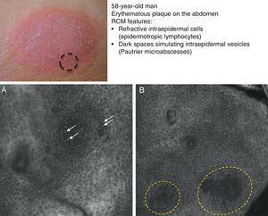 Clinical image of plaque-stage mycosis fungoides. A, RCM image (0.5×0.5mm) of the superficial stratum spinosum showing disruption and bright cells (epidermotropism, white arrows) between the keratinocytes. B, RCM image (0.5×0.5mm) of the stratum spinosum, showing small dark spaces corresponding to Pautrier microabscesses (dashed circles). Note the highly reflective cells (atypical lymphocytes) in the interior. RCM indicates reflectance confocal microscopy.