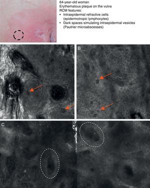 Clinical image of extramammary Paget disease. A, RCM image (0.5×0.5mm) (stratum corneum/stratum granulosum), showing infiltration by weakly refractive, dark Paget cells (arrows). B, RCM image (0.5×0.5mm) of the stratum spinosum, showing invasion by large Paget cells (arrows) that are twice or three times the size of the surrounding keratinocytes and disrupt the characteristic honeycomb pattern. C, RCM image (1×0.5mm) of the dermal-epidermal junction, showing blurring of rings (dashed circles) containing an inflammatory infiltrate. RCM indicates reflectance confocal microscopy.