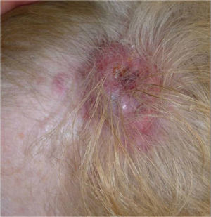 Erythematous violaceous tumor with a 4-cm diameter and peripheral macular lesions.