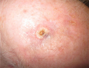 Photograph of lesion after completion of treatment with bevacizumab and paclitaxel.