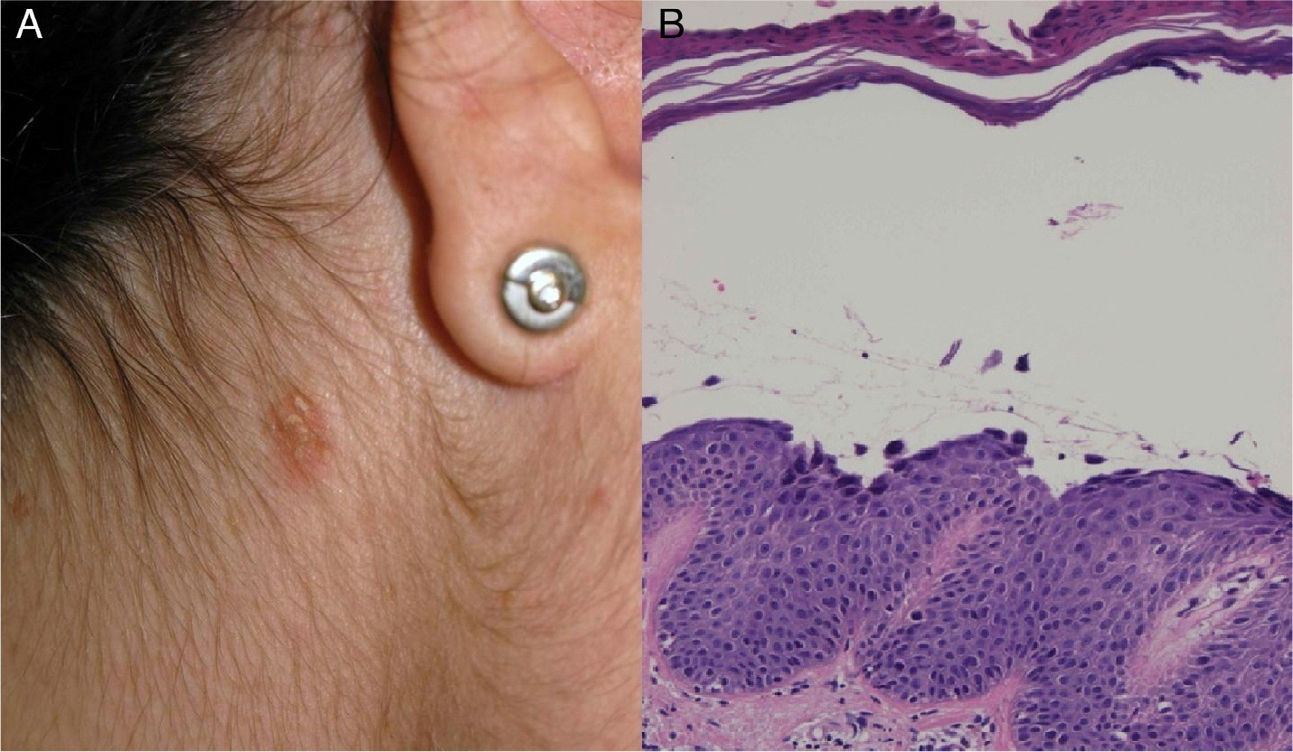dermatitis herpetiformis pathology outlines