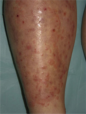 Erythematous papules and plaques with circinate borders and peripheral vesicles.