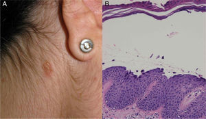 A, Erythematous scaling plaque in the retroauricular area. B, Acantholytic subcorneal vesicle (hematoxylin eosin, original magnification ×400).