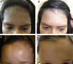 A and B. Bilateral nevus of Ota before and after the cosmetic camouflage session. C and D. Hypomelanosis of Ito before and after the camouflage session.