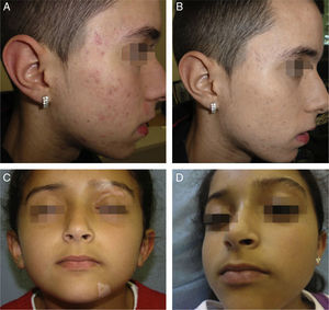A and B. Acne scars before and after the camouflage session. C and D. Segmental vitiligo before and after the camouflage session.