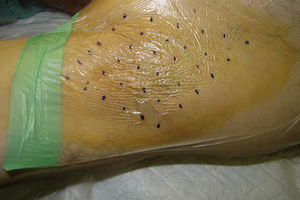 Division of the axilla into quadrants, with the sites of injection situated in the center.