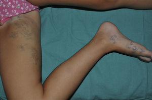 Segmentally distributed bluish plaque extending from the right groin along the medial aspect of the right thigh and leg to the right foot.