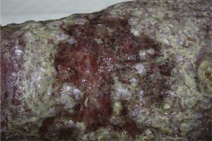 Ulcer on the left calf. Note the erythematous surface, which is papilliform in appearance, and abundant exudate. Several larvae can be seen on the surface of the lesion.
