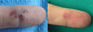 A, Patient 3 had a bleeding and painful acquired digital arteriovenous malformation on the palmar surface of the 2nd finger of the right hand. B, Partial resolution after 3 treatment sessions. Recurrence of the vessels was observed on follow-up, but as the lesion remained asymptomatic, no more treatment was applied.