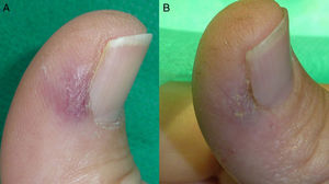 A, Patient number 6 had a painful acquired digital arteriovenous malformation located close to the lateral periungual fold. B, significant improvement was achieved without scarring or nail deformity after 1 laser session.