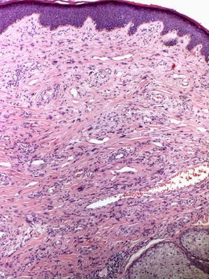 Dome-shaped growth formed by a dermal proliferation of fibroblasts and dilated blood vessels, surrounded by collagen fibers. Hyperkeratotic epidermis with melanocytic hyperplasia (hematoxylin-eosin, original magnification ×10).