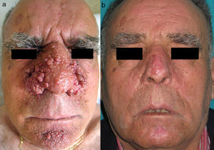 A, Patient with multiple large facial angiofibromas. B, Result 9 months after treatment with electrosurgery.