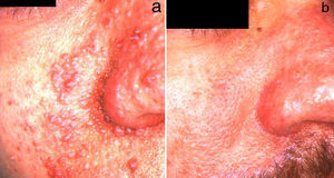 A, Localized facial angiofibromas on the nose, cheek, and nasolabial fold. B, Result after treatment with CO2 laser. Courtesy of Dr Pablo Boixeda.