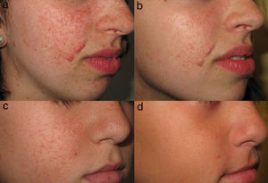 A and C, Multiple facial angiofibromas in patients with tuberous sclerosis. B and D, Improvement in erythema, size, and extent of the lesions after 9 months of treatment with 0.4% sirolimus ointment.