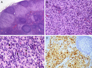A, Lymph nodes affected by Langerhans cell histiocytosis (hematoxylin-eosin, original magnification ×2). B, Subcapsular sinus occupied and expanded by a predominantly mononuclear cell population containing some eosinophils (hematoxylin-eosin, original magnification ×20). C and D, Higher magnification images showing the eosinophils (arrowheads in C; hematoxylin-eosin, original magnification ×40) and the grooves or folds in the elongated nuclei of the CD1a+ Langerhans cells (D; CD1a, original magnification ×10).