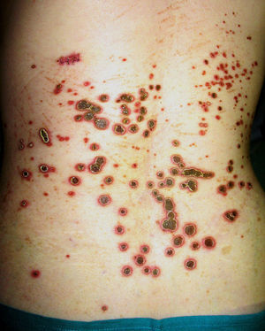 Multiple papules and plaques on the dorsal and lumbar region of the back in patient 6; the lesions have a central hyperkeratotic plug and an erythematous halo.