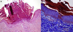 A, Cup-shaped central depression covered by keratin and cell remnants (hematoxylin-eosin, original magnification×10). B, Transepidermal elimination of verticalized collagen fibers (Masson trichromic stain, original magnification×20).