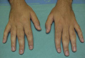 Bilateral symmetric swelling of the lateral surface of the proximal interphalangeal joints of the second, third, fourth, and fifth fingers of both hands.