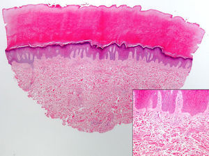 Histological examination showed a thickened dermis with thickened collagen bundles and increased numbers of fibroblasts, without inflammation. The epidermis showed orthokeratotic hyperkeratosis (hematoxylin-eosin, original magnification ×5). The inset on the right shows the collagen bundles and fibroblasts at higher magnification (hematoxylin-eosin original magnification ×20).