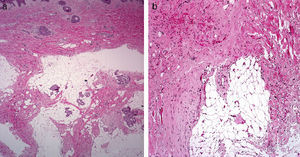 A, Hematoxylin-eosin, original magnification ×40. B, Hematoxylin-eosin, original magnification ×100.