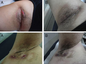 Hidradenitis suppurativa: Bilateral axillary involvement. Results for patients 1 (above) and 2 (below) mentioned in Table 1. A, Before treatment. B, At 8 weeks’ follow-up.Treatment response was satisfactory in patient 1. Considerable reduction of inflammatory lesions and decreased signs of disease activity were observed in patient 2.