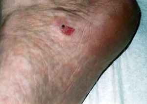 Circumscribed plantar hypokeratosis. A lesion with similar characteristics to those of Fig.1, but in a much less common site (source, Dr. Arno Rütten, with permission).