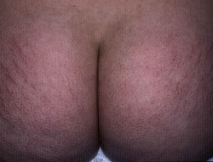 Follicular hyperkeratotic papules secondary to keratosis pilaris on the buttocks, accompanied by striae.