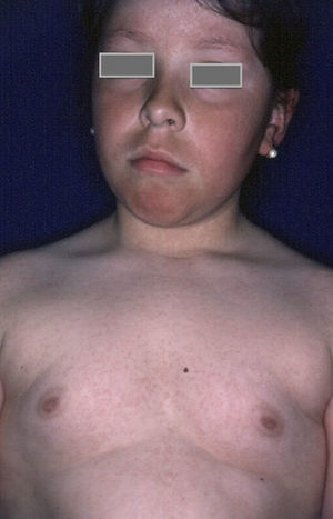 Rubeosis faciei in an overweight child with diabetes who also presented keratosis pilaris on the trunk.