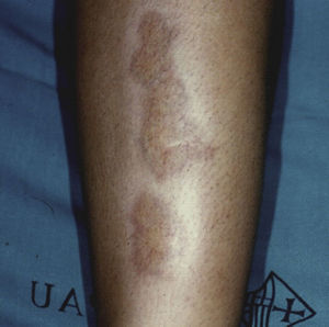 Necrobiosis lipoidica on the anterior aspect of the leg.