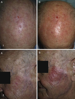 A, Baseline appearance of treated actinic keratosis lesions. B, Erythema and inflammation 3h after treatment. The lesions in the upper photographs (1A and B) were treated with daylight photodynamic therapy (PDT). The lesions in the lower photographs (2A and B) were treated with conventional PDT. Photographs from Hospital San Jorge.