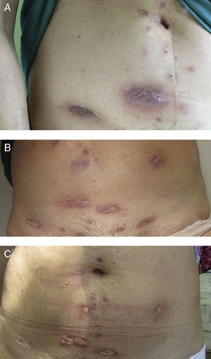 Lesions on the abdomen. A, Before ustekinumab. B, After 1 month of ustekinumab. C, After 8 months of ustekinumab.