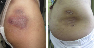 Lesion on the buttocks. A, After 1 month of ustekinumab. B, After 8 months of ustekinumab.