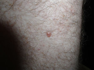 Papular skin-colored lesion on the left thigh.