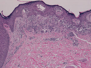 Proliferation of melanocytes in the epidermis and papillary dermis, with mild architectural disorder (hematoxylin-eosin, original magnification ×40).