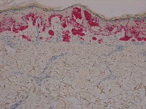 Nests of melanocytes in the basal layer of the epidermis with sparse single melanocytes in the upper layers (Melan-A, original magnification ×100).