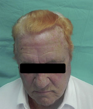 Probable Iatrogenic Xanthotrichia | Actas Dermo-Sifiliográficas