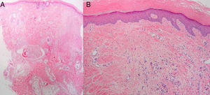 A, Biopsy of the parietal region of the scalp (hematoxylin-eosin, original magnification ×2; panoramic image) B, Hematoxylin-eosin, original magnification ×4. Histopathological findings: marked orthokeratotic hyperkeratosis and mild acanthosis; focal dermal fibrosis with proliferation of small vessels and perivascular lymphocytic infiltrates.