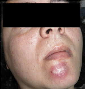 Clinical image. Erythematous-brownish nodule of 2cm diameter, situated on the chin.
